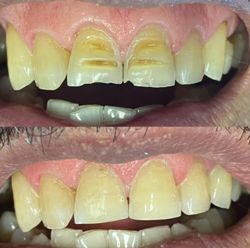 Transformación dental con carillas estéticas, resultado natural y luminoso