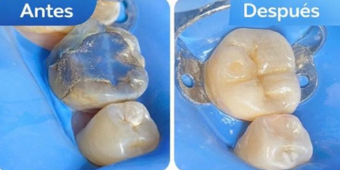 Resultado de restauración dental estética con materiales de última generación