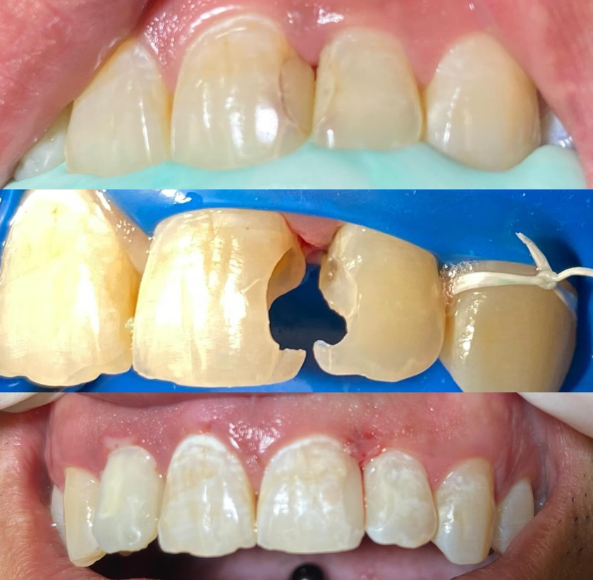 Restauración dental compleja con técnicas adhesivas avanzadas en Alfa Dental Care