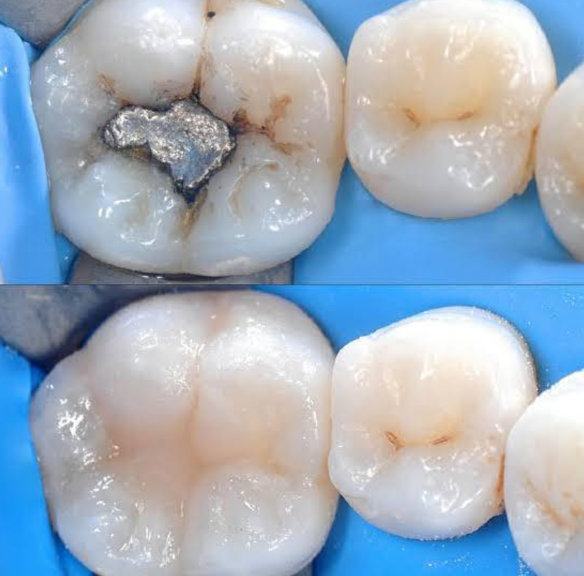 Caso de restauración dental mostrando la precisión del trabajo estético realizado